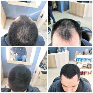 Fibras capilares para disimular la calvicie y el adelgazamiento del cabello, creando un look más denso.